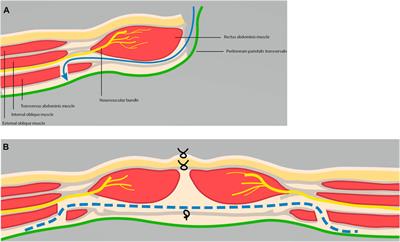 Assessing Textbook Outcome After Implementation of Transversus Abdominis Release in a Regional Hospital